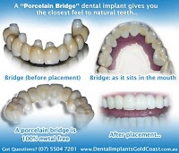 Gold Coast Dental Implants 170495 Image 3