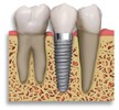 Ipswich and Brisbane Dental Implants and Cosmetic Dentistry 177269 Image 2