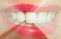 Uniquely You Teeth Whitening 179501 Image 3