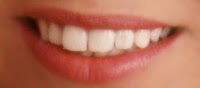 Uniquely You Teeth Whitening 179501 Image 6